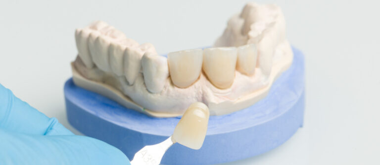 veneers